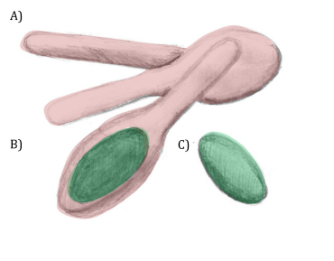 Ryc. 1. Morfologia laseczek C. botulinum: A) laseczka niezawierająca przetrwalnika; B) laseczka z charakterystycznie zlokalizowanym przetrwalnikiem (endosporą); C) egzospora poza komórką macierzystą